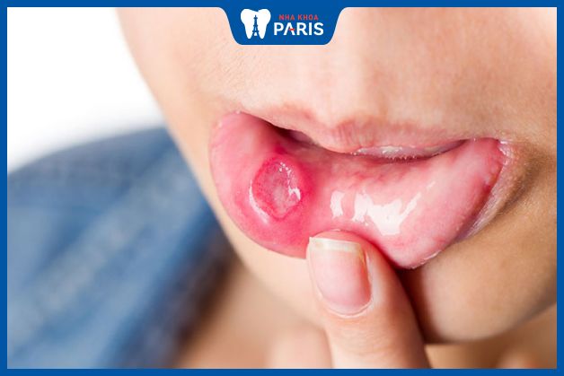 Loét miệng kéo dài là dấu hiệu của ung thư khoang miệng