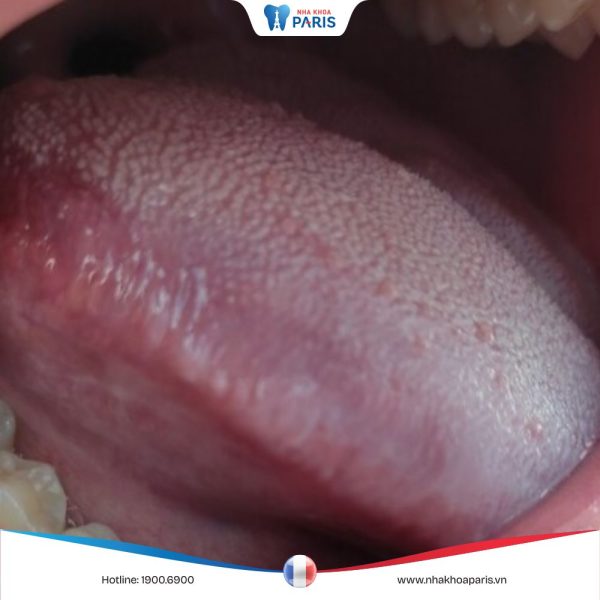 Hình ảnh viêm gai lưỡi: Nhận biết sớm, điều trị sớm