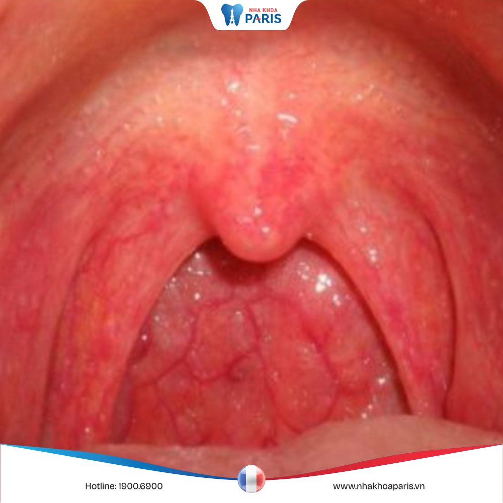 Hình ảnh vòm họng bình thường và họng của người bị viêm