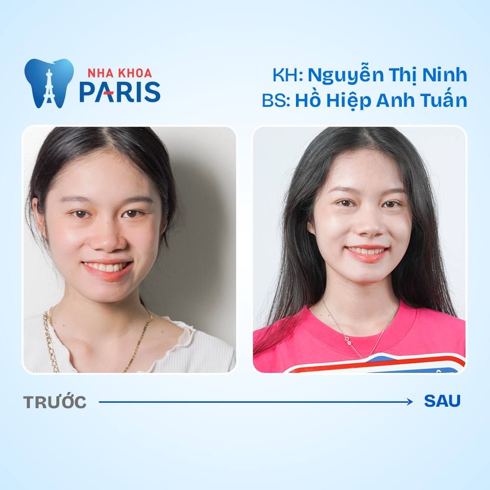 những nơi niềng răng uy tín ở tphcm