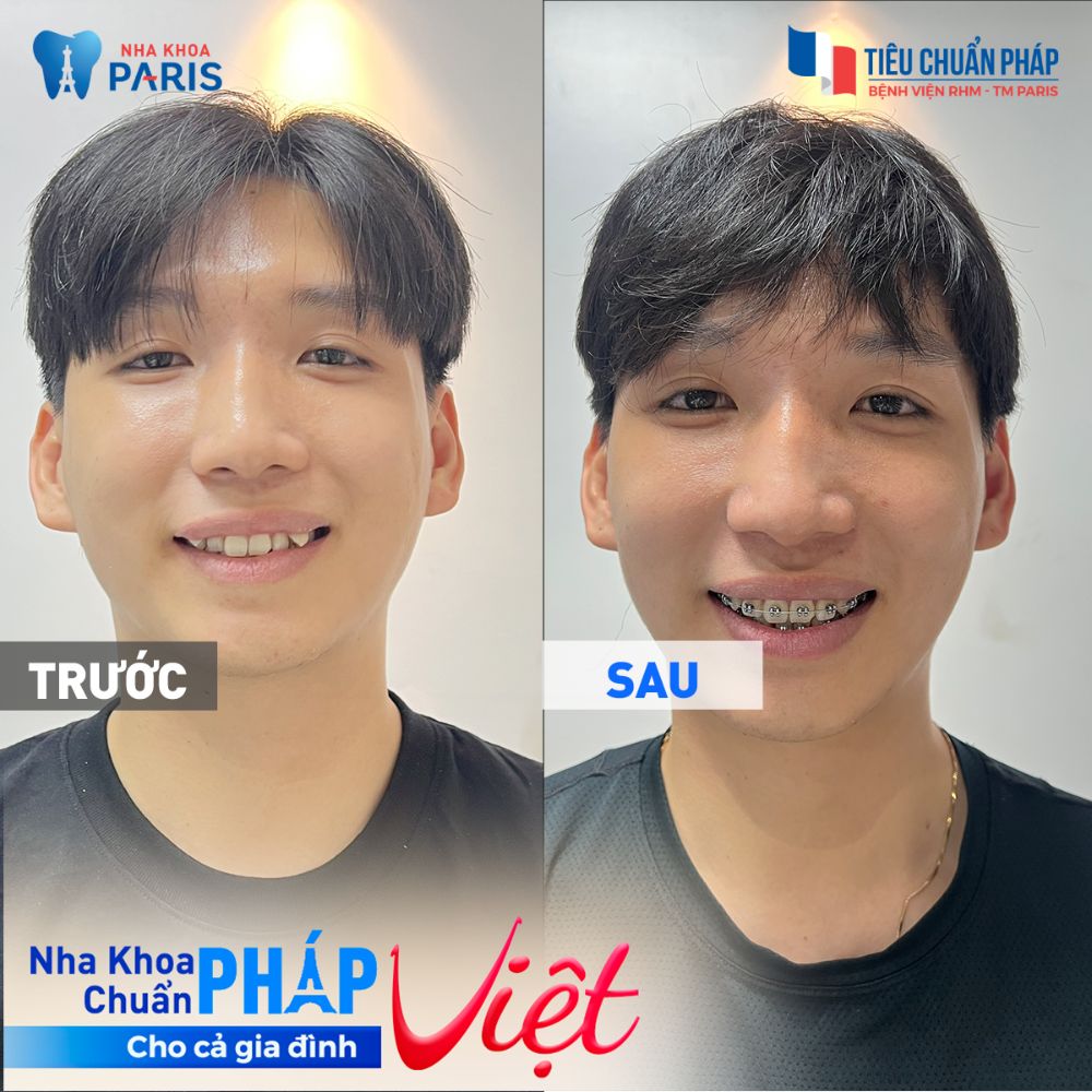 Khách hàng Trương Dỹ sau khi niềng răng 3 tháng