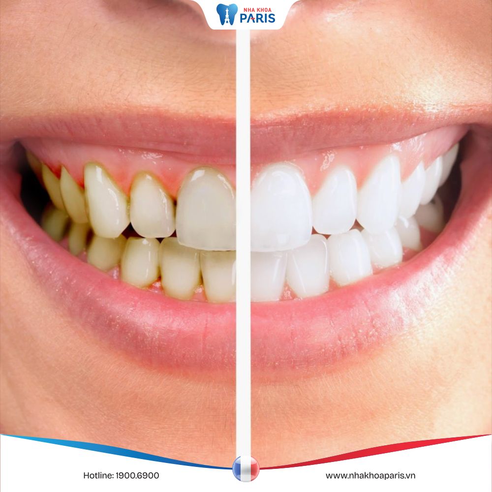 Lấy cao răng nhiều có hại cho men răng không? Bác sĩ trả lời