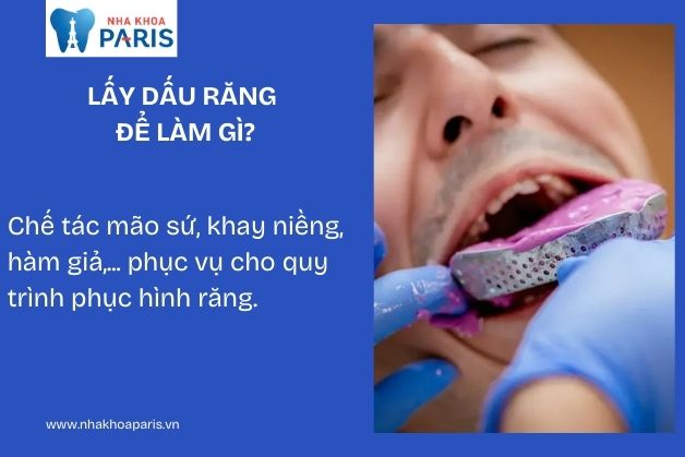 Lấy dấu răng là kỹ thuật phổ biến trong nha khoa