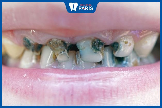 Sai khớp cắn làm tăng nguy cơ bị bệnh răng miệng