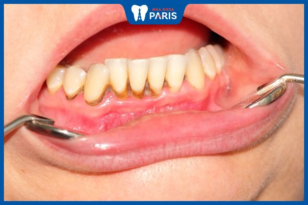 Mảng bám trên răng khiến vi khuẩn phát triển
