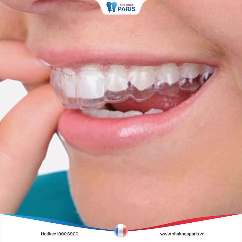 Máng chống nghiến răng: Giải pháp cho vấn đề nghiến răng