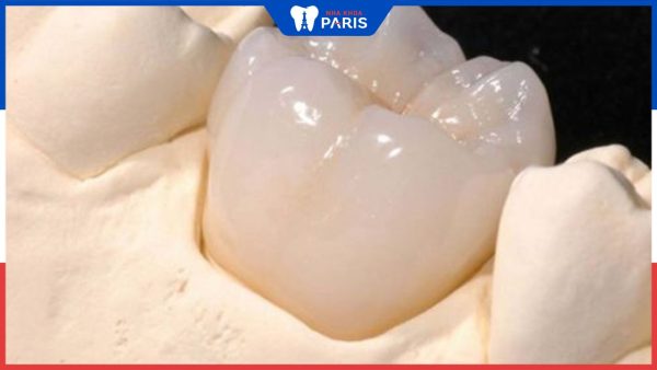 Mão răng là gì? Các loại mão răng sứ thường gặp và một số lưu ý