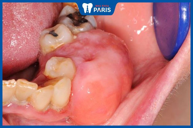 Nang răng gây sưng tấy và làm biến dạng mặt