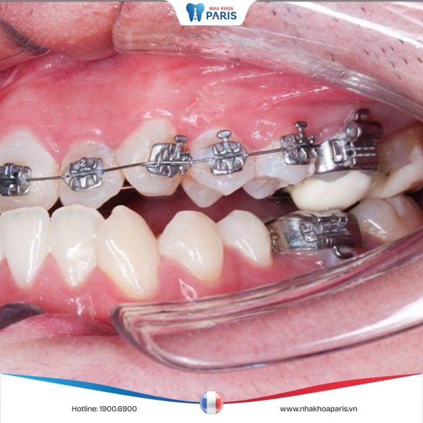 Nâng khớp cắn trong niềng răng là gì? Thời gian bao lâu