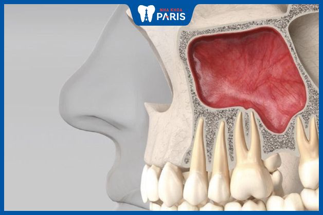 Nâng xoang hàm giúp xương hàm có đủ thể tích để neo giữ Implant