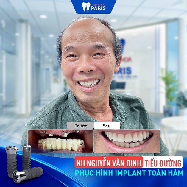 Khách hàng Nguyễn văn Dinh phục hình Implant toàn hàm
