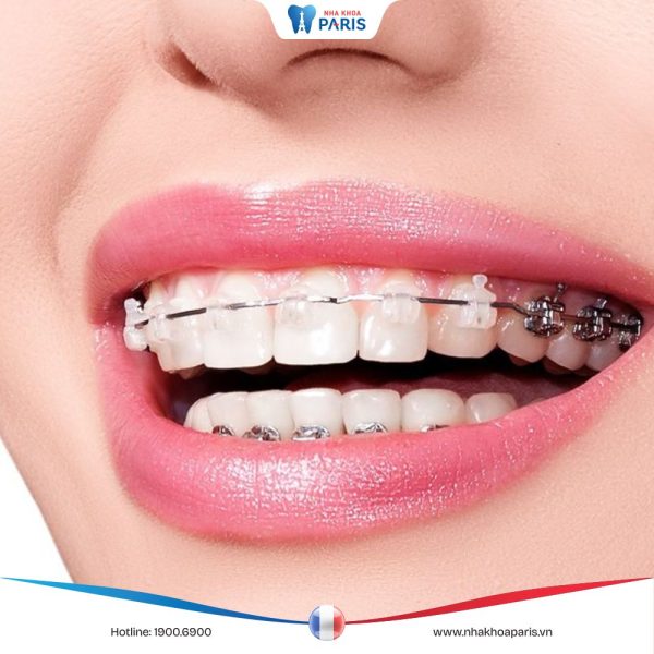 Tìm hiểu nẹp răng thẩm mỹ? Lưu ý trước và sau khi nẹp