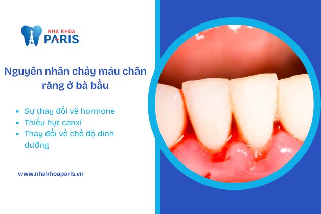 Một số nguyên nhân chính gây ra chảy máu chân răng ở phụ nữ mang thai