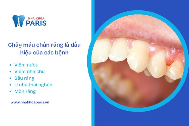 Chảy máu chân răng là cảnh báo một số bệnh nguy hiểm cho mẹ bầu và thai nhi