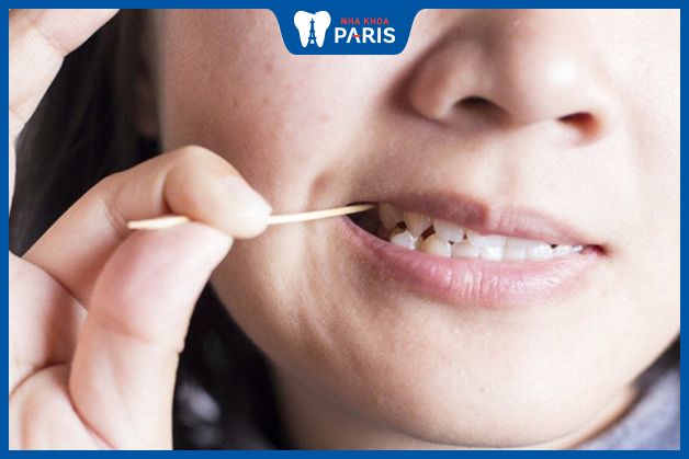 Dùng tăm tre xỉa răng làm tăng nguy cơ bị tụt lợi
