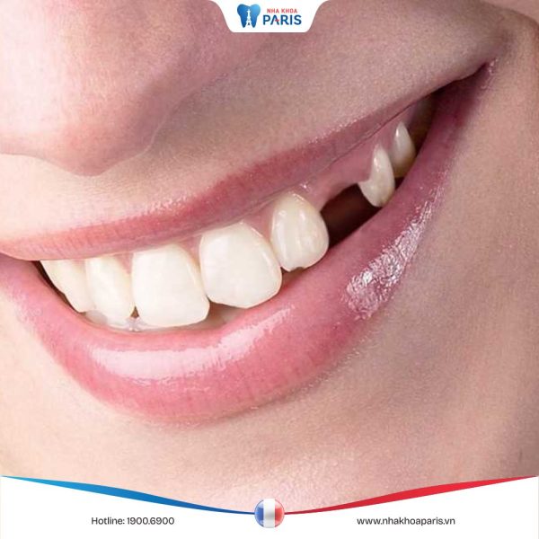 Răng số 4 là răng nào? Nhổ răng 4 có nguy hiểm không