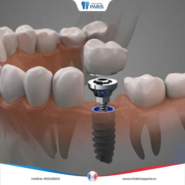 Sau khi nhổ răng bao lâu thì trồng Implant là phù hợp nhất