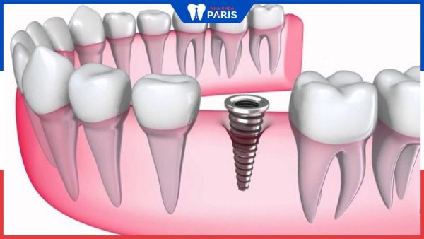 Sau nhổ răng bao lâu thì cấy răng Implant là phù hợp nhất