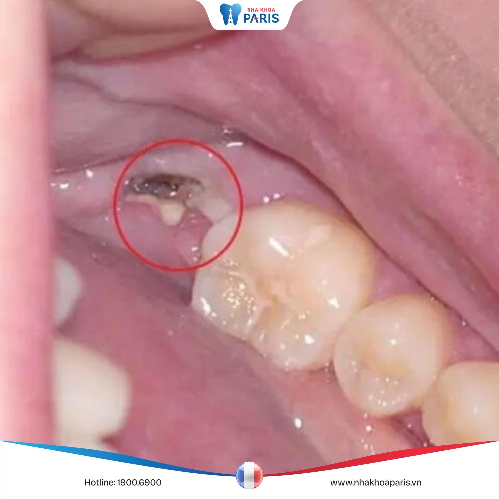 Nhổ răng còn sót chân răng do đâu? Cách nhận biết và xử lý đúng