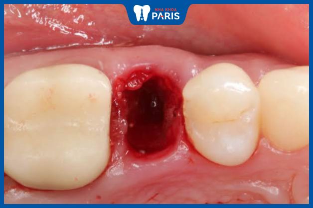 Bong cục máu đông có thể gây ra tình trạng chảy máu sau nhổ răng kéo dài