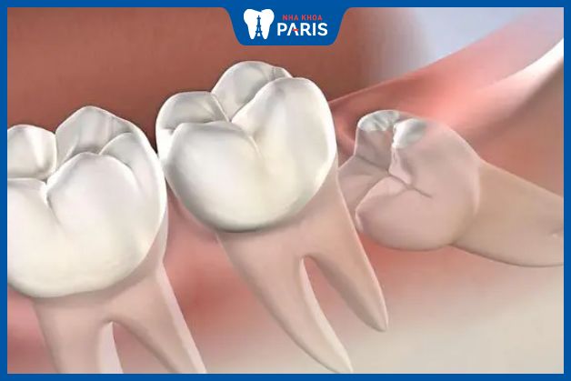 Cần nhổ răng hàm mọc lệch khi chúng ảnh hưởng đến răng kế cận 