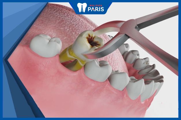 Nhổ răng hàm xâm lấn mô nhiều có thể ảnh hưởng đến dây thần kinh
