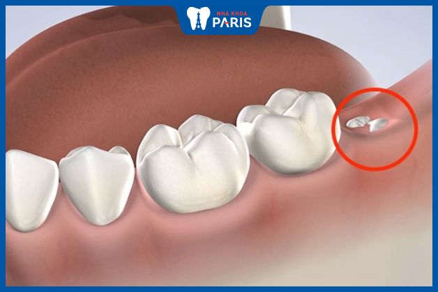 Răng khôn thường mọc ở độ tuổi trưởng thành từ 18-25 tuổi