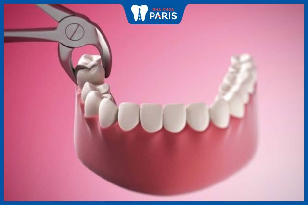 Nhổ răng số 8 bằng kìm gây ra nhiều đau đớn, tiềm ẩn nguy cơ biến chứng