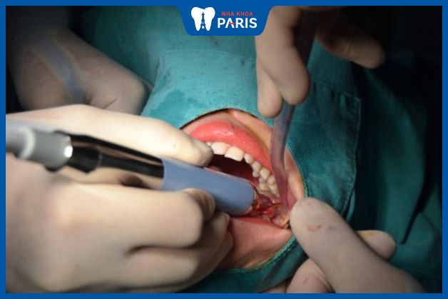 Nhổ răng bằng máy siêu âm Piezotome tuy chi phí cao nhưng ít xâm lấn, giảm đau đớn cho người bệnh