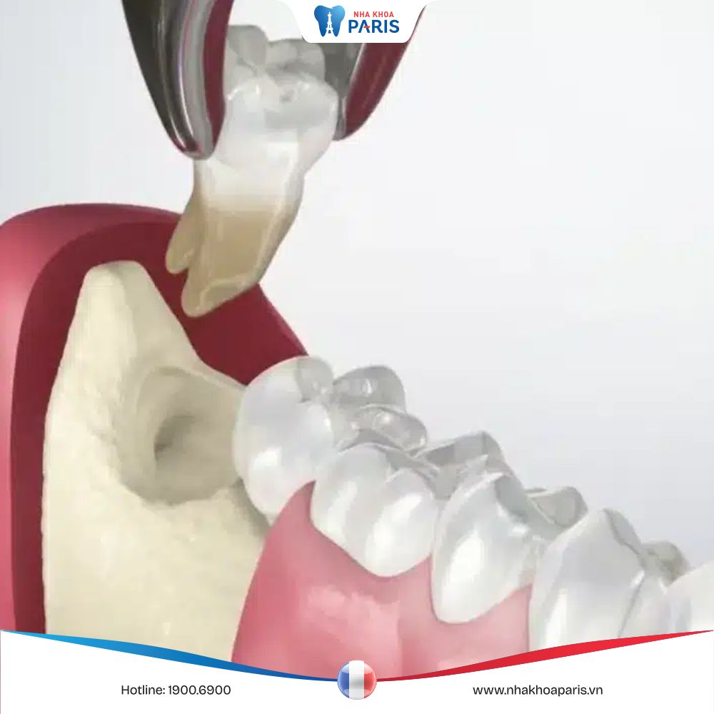 Nhổ răng khôn có đau không? Quy trình nhổ răng khôn hiện đại