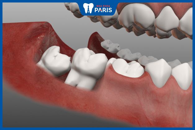Nhổ răng khôn hàm dưới không nguy hiểm nếu dược thực hiện tại cơ sở nha khoa uy tín