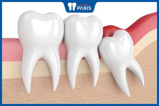 Trường hợp răng khôn mọc ngầm hầu hết được chỉ định nhổ bỏ