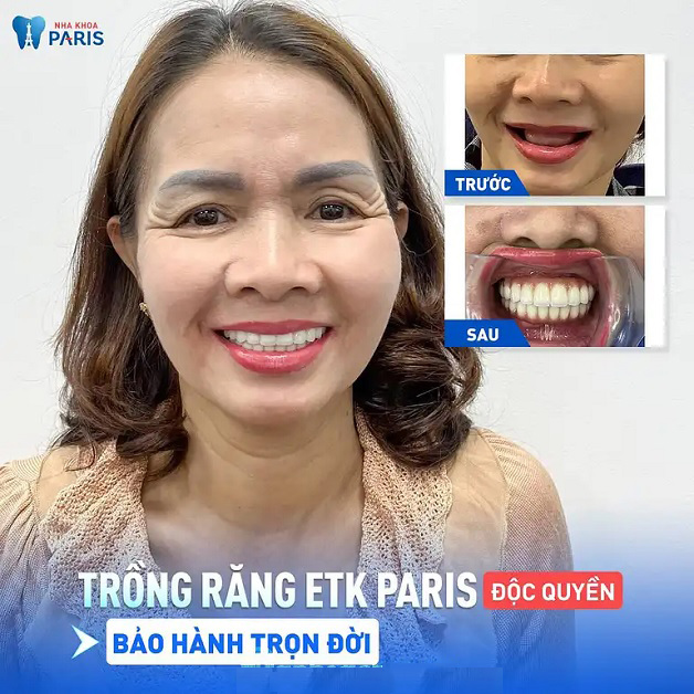 Khách hàng sở hữu hàm răng đều đẹp sau khi trồng răng Implant ETK Paris