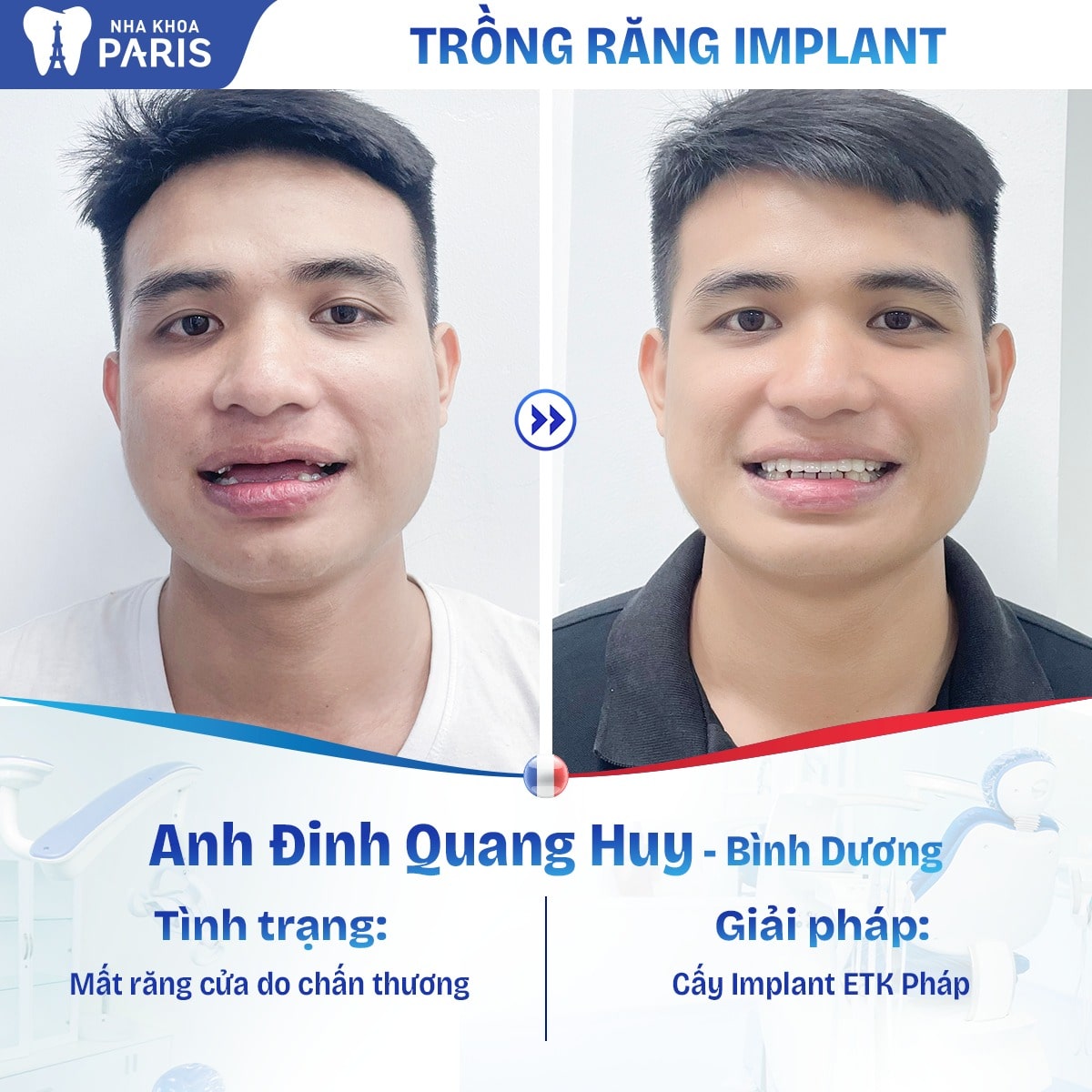Khách hàng Quang Huy lựa chọn giải pháp cấy ghép Implant ETK Pháp