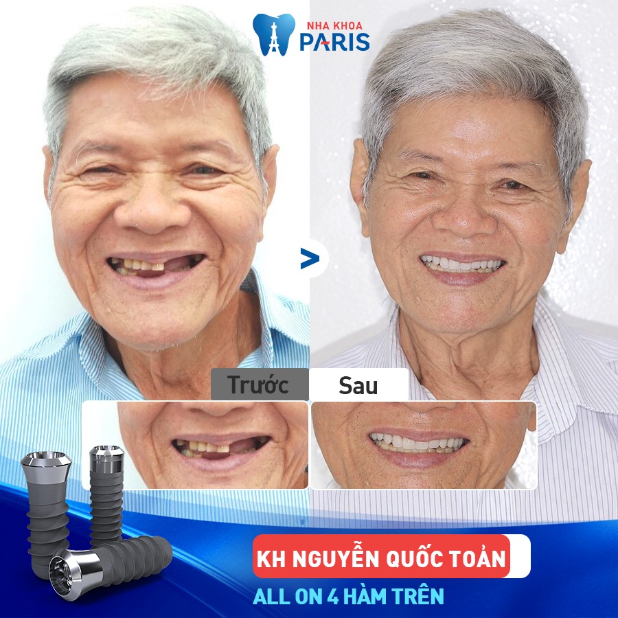 Khách hàng Nguyễn Quốc Toản được khôi phục chức năng ăn nhai sau khi trồng răng tại Nha Khoa Paris