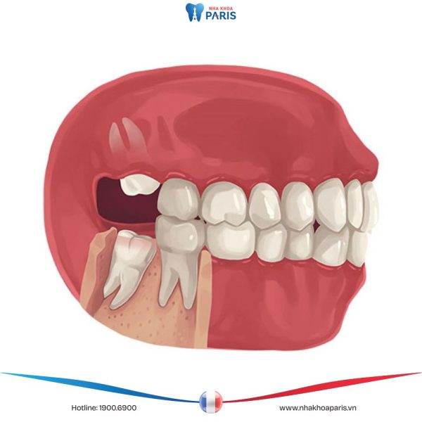 Nhổ răng số 8 có nguy hiểm không – Bác sĩ nha khoa giải đáp