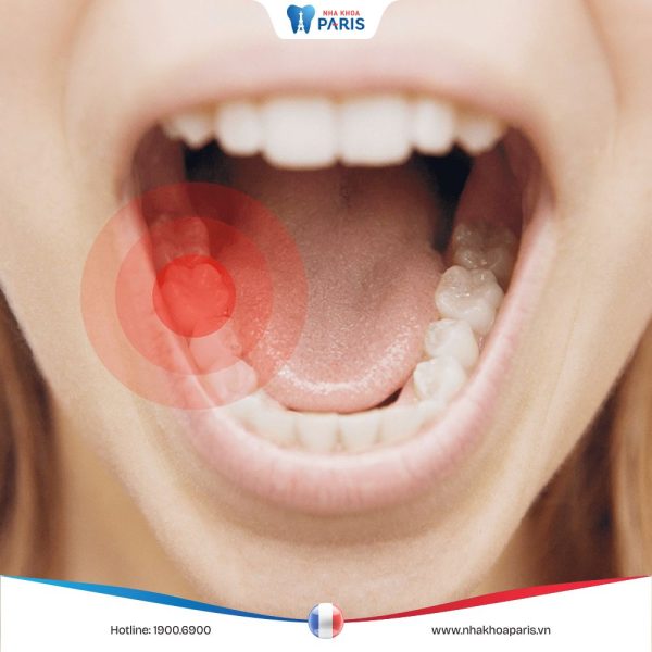 Đau nhức răng phải làm sao | 6 cách giảm đau hiệu quả