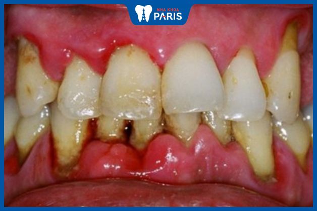 viêm nha chu có thể khiến nướu bị tụt, khiến phần chân răng sứ lộ ra ngoài