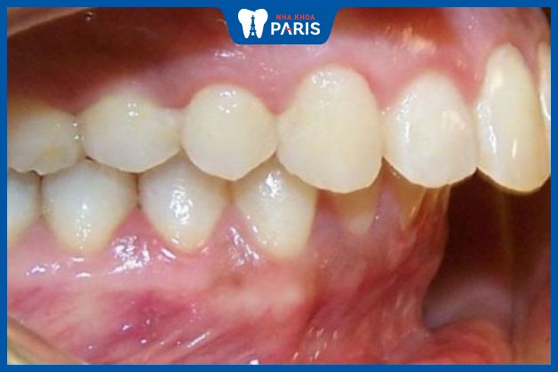 Răng bị hô, móm nhiều cần niềng răng thay vì bọc răng sứ