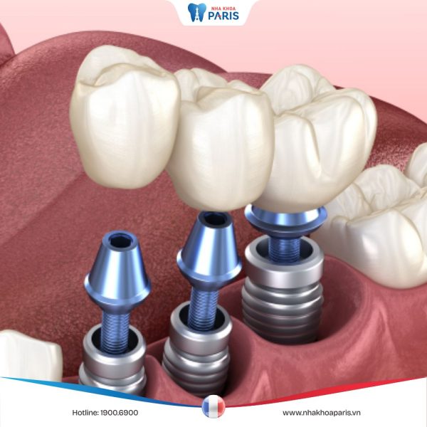 Nhược điểm của trồng răng Implant bạn không nên bỏ qua
