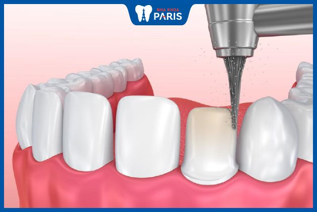 Bọc răng sứ có chi phí cao hơn hàn trám hay tẩy trắng răng