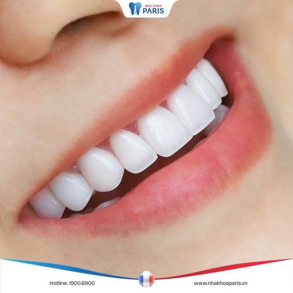 6 nhược điểm của việc bọc răng sứ có thể bạn chưa biết