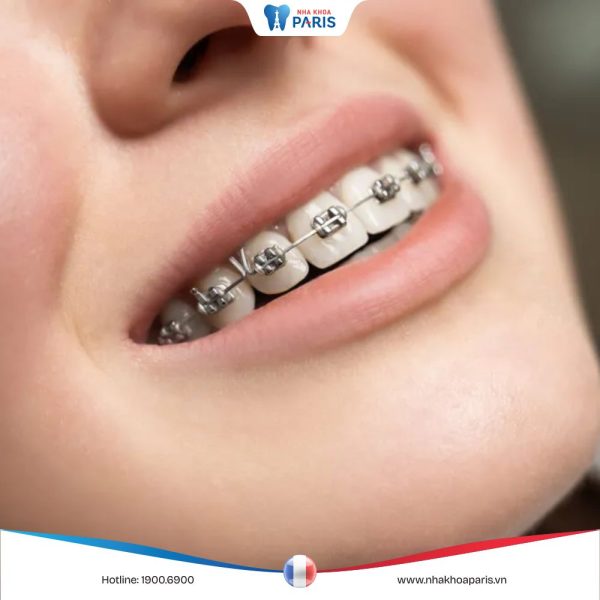 Niềng răng có đau không? Giai đoạn nào là đau nhất