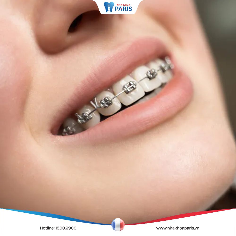 Niềng răng có đau không? Biện pháp giảm đau khi niềng răng