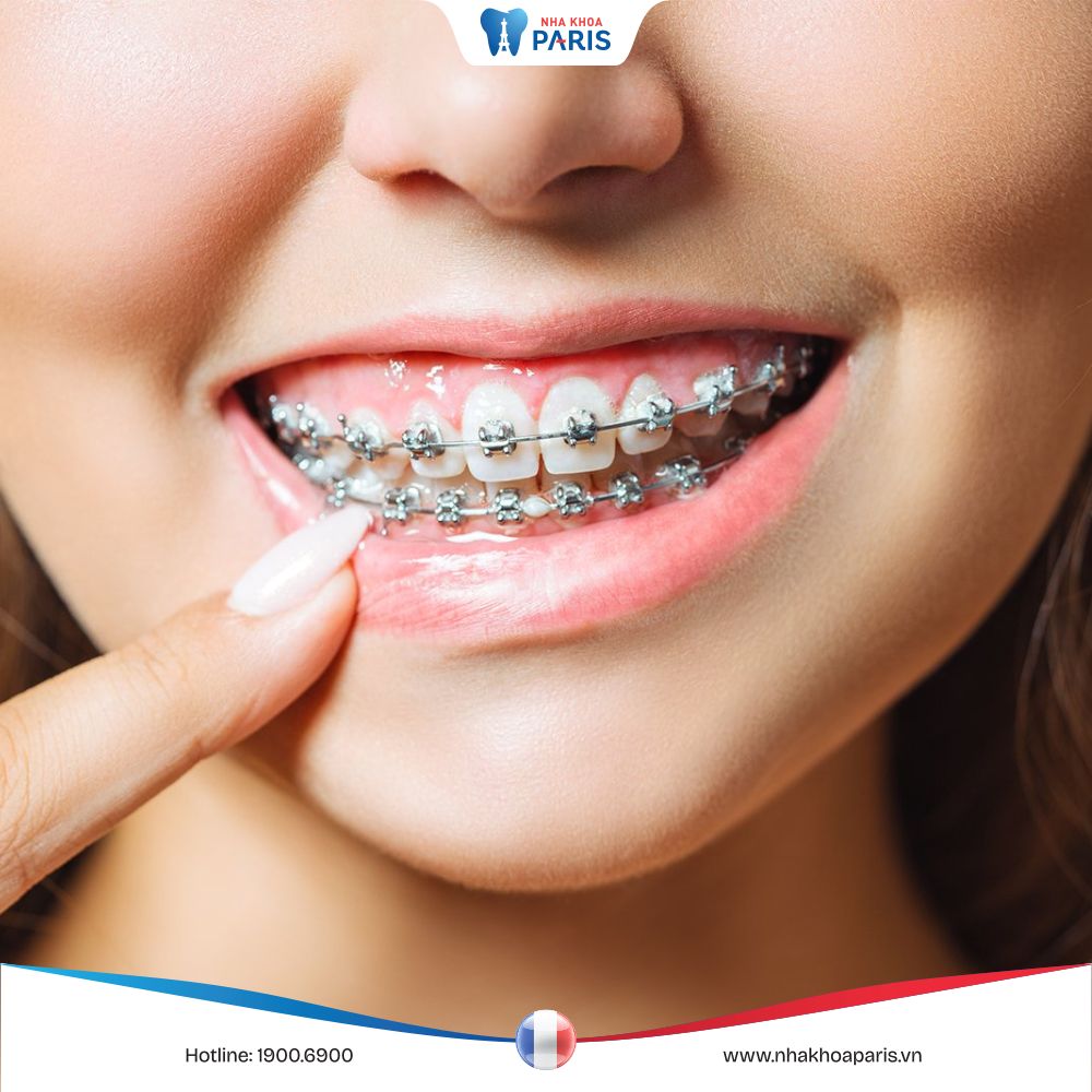 Giải đáp: Niềng răng có làm thay đổi khuôn mặt không?