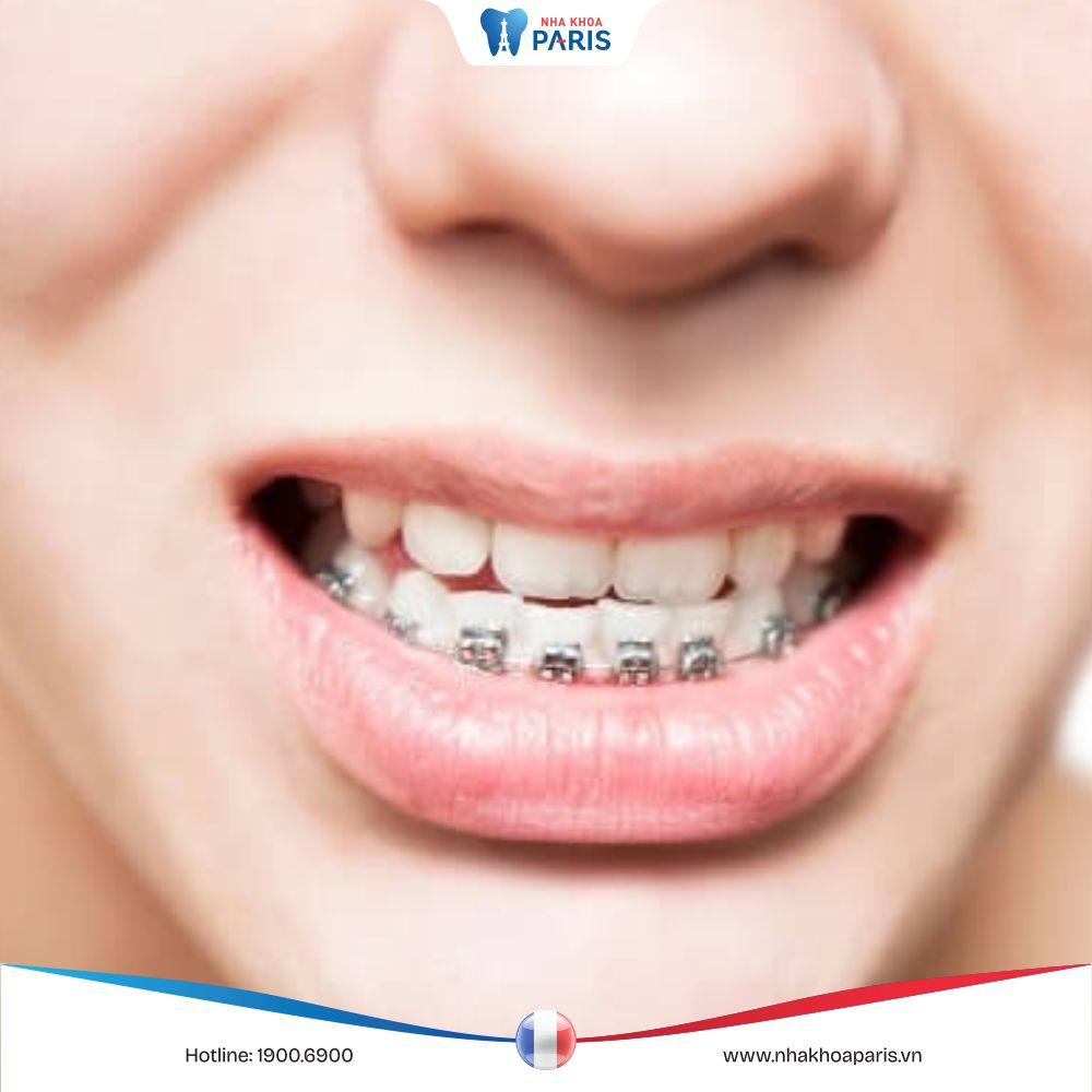 Niềng răng hàm dưới an toàn – hiệu quả – tiết kiệm