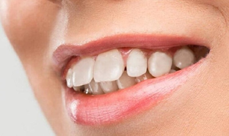 Tình trạng 2 hàm răng không khít, răng chìa ra trước