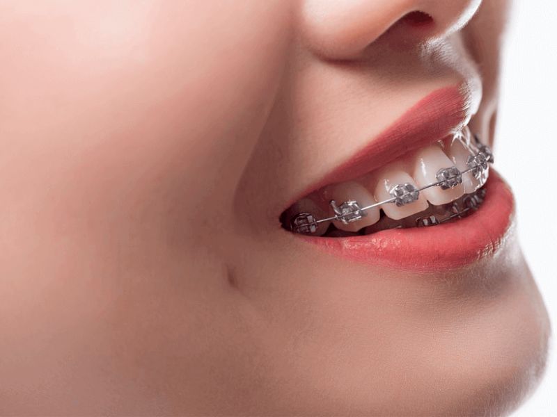 Niềng răng hô giúp khắc phục tình trạng răng khấp khểnh, cải thiện khả năng ăn nhai