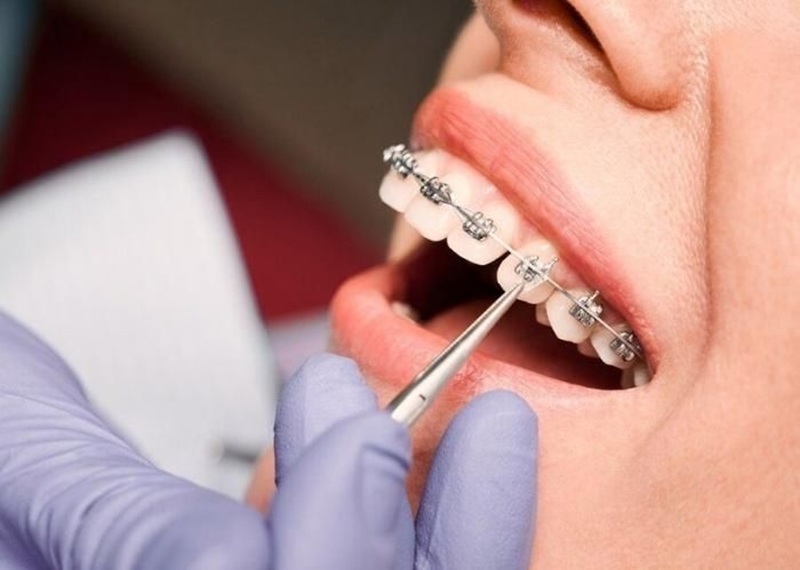 Bác sĩ thực hiện niềng răng hô an toàn, chuẩn y khoa