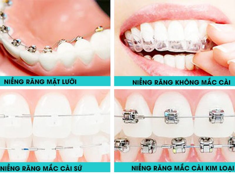 Có nhiều phương pháp niềng răng hô được áp dụng hiện nay